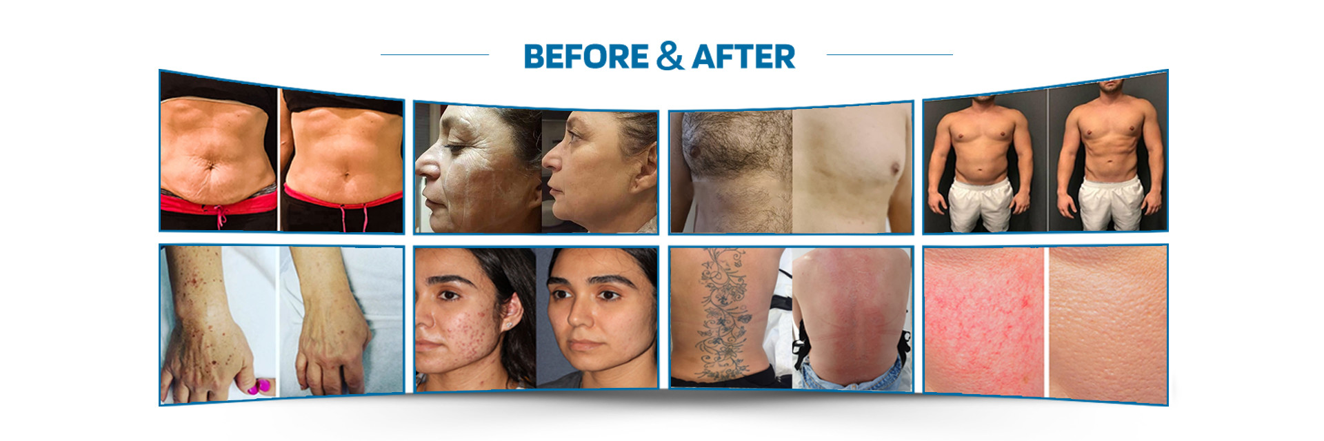 جودة آلة إزالة الشعر بالليزر مصنع