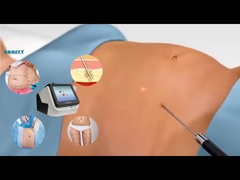 معدات ليزر ليبو 30W 60W 980nm آلة ليزر ليبو للخسارة الوزن